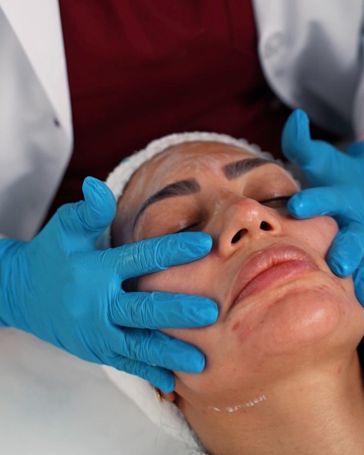 chemical peel